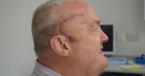 brain tumor surgery scar